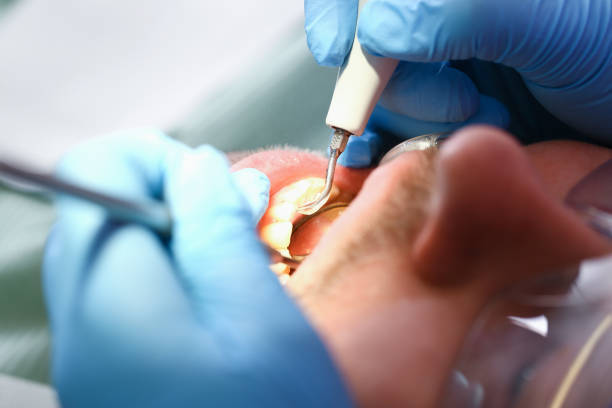 Best Emergency Tooth Extraction in Riverton, UT